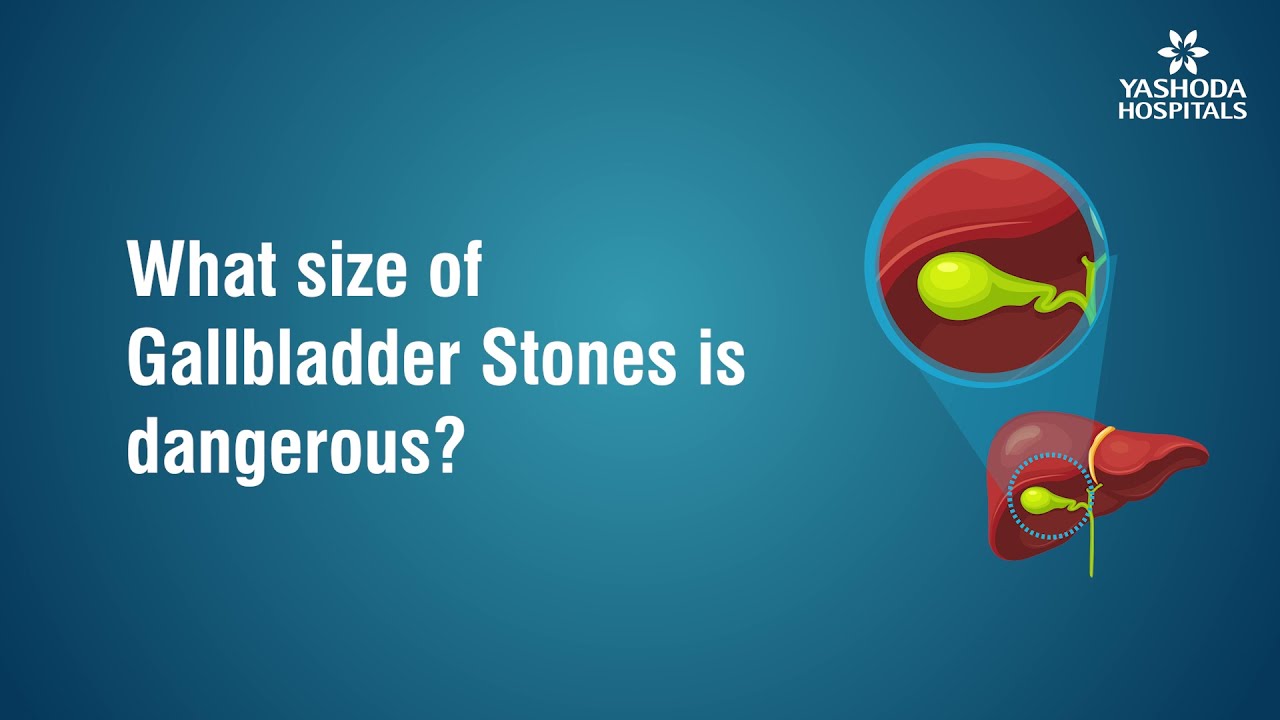 What size of Gallbladder Stone is dangerous?